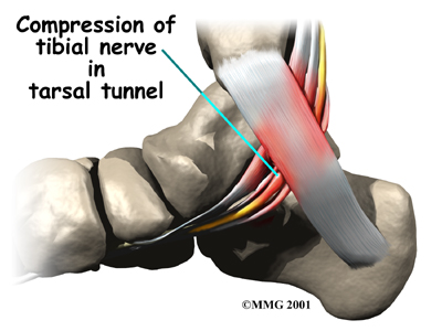 foot_tarsal_tunnel_causes01