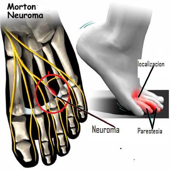 neuroma_de_morton1