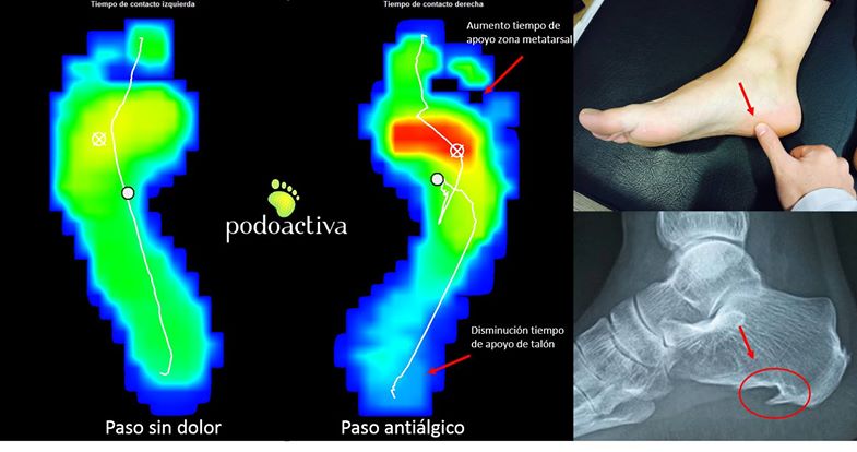 fascitis_plantar_podoactiva_podologia