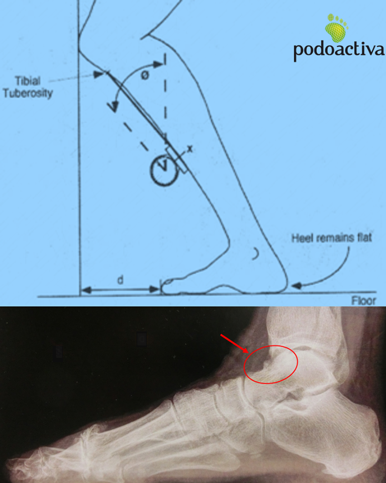 post_impingement