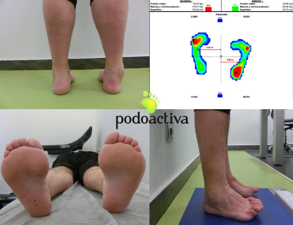 pies_cavos_neurologicos_podoactiva