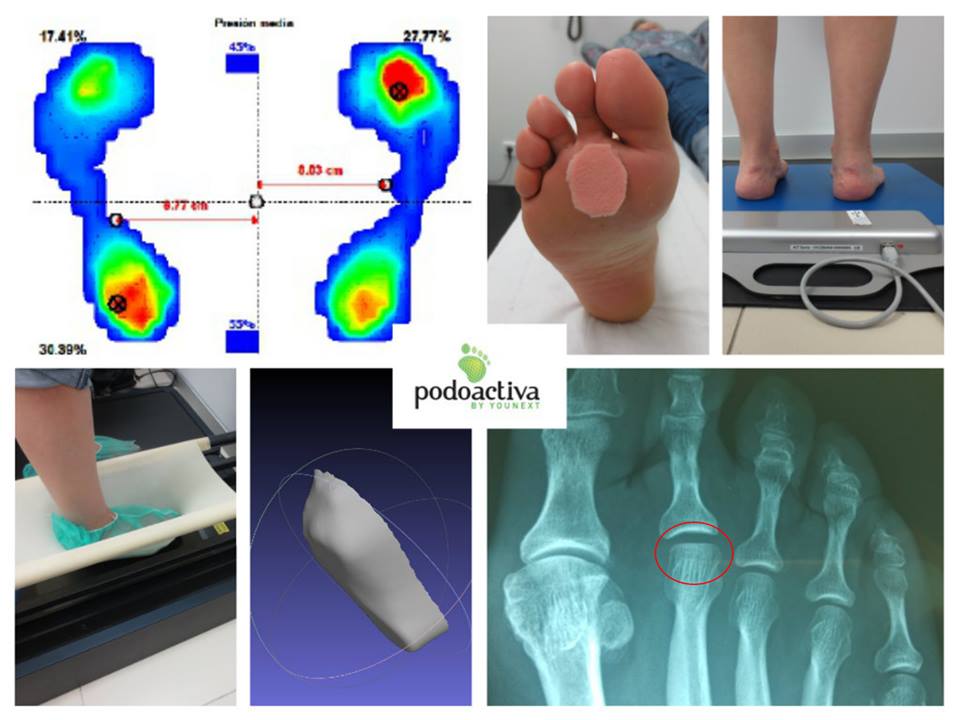 metatarsalgia_por_enfermedad_de_freiberg_podoactiva