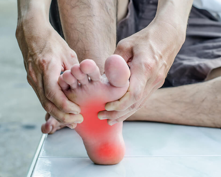 pie con la planta roja por un dolor debido a la fascitis plantar