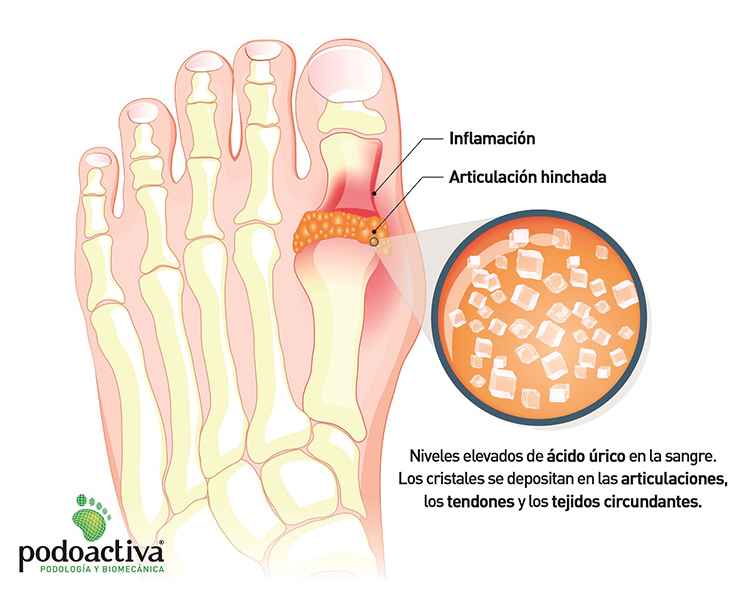 Infografía sobre la gota en el dedo gordo de Podoactiva