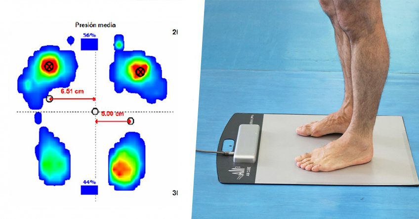 Estudio biomecánico de la pisada y resultado de estudio de presiones plantares sobre un paciente con pie diabético sin plantillas